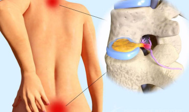Disc Herniations