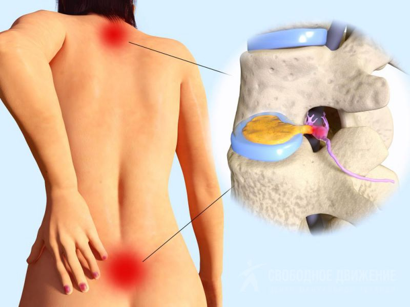 Disc Herniations