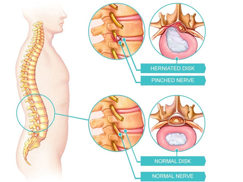Disc Herniations