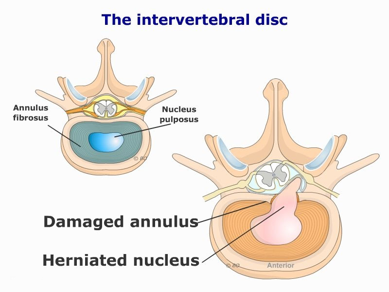 Disc Herniations