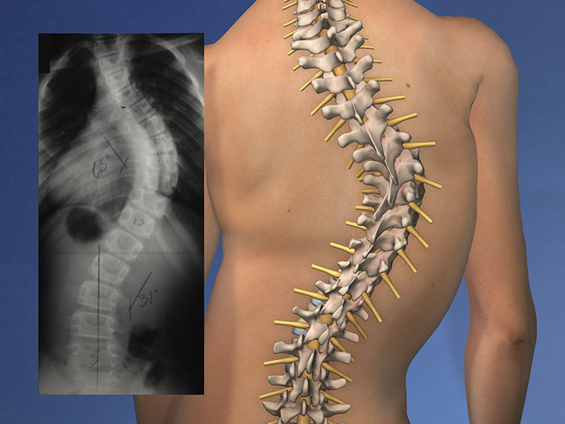 Spinal Deformities