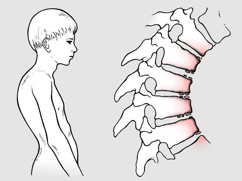 Spinal Deformities