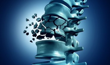 Spinal Fractures