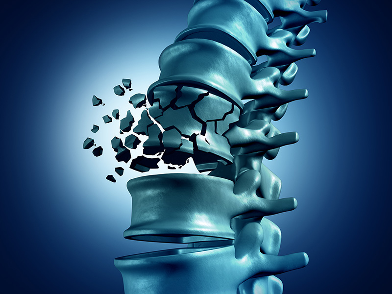 Spinal Fractures