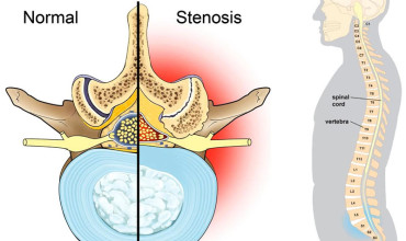 Spinal Stenosis