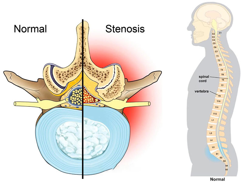 Spinal Stenosis