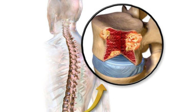 Spinal Tumors